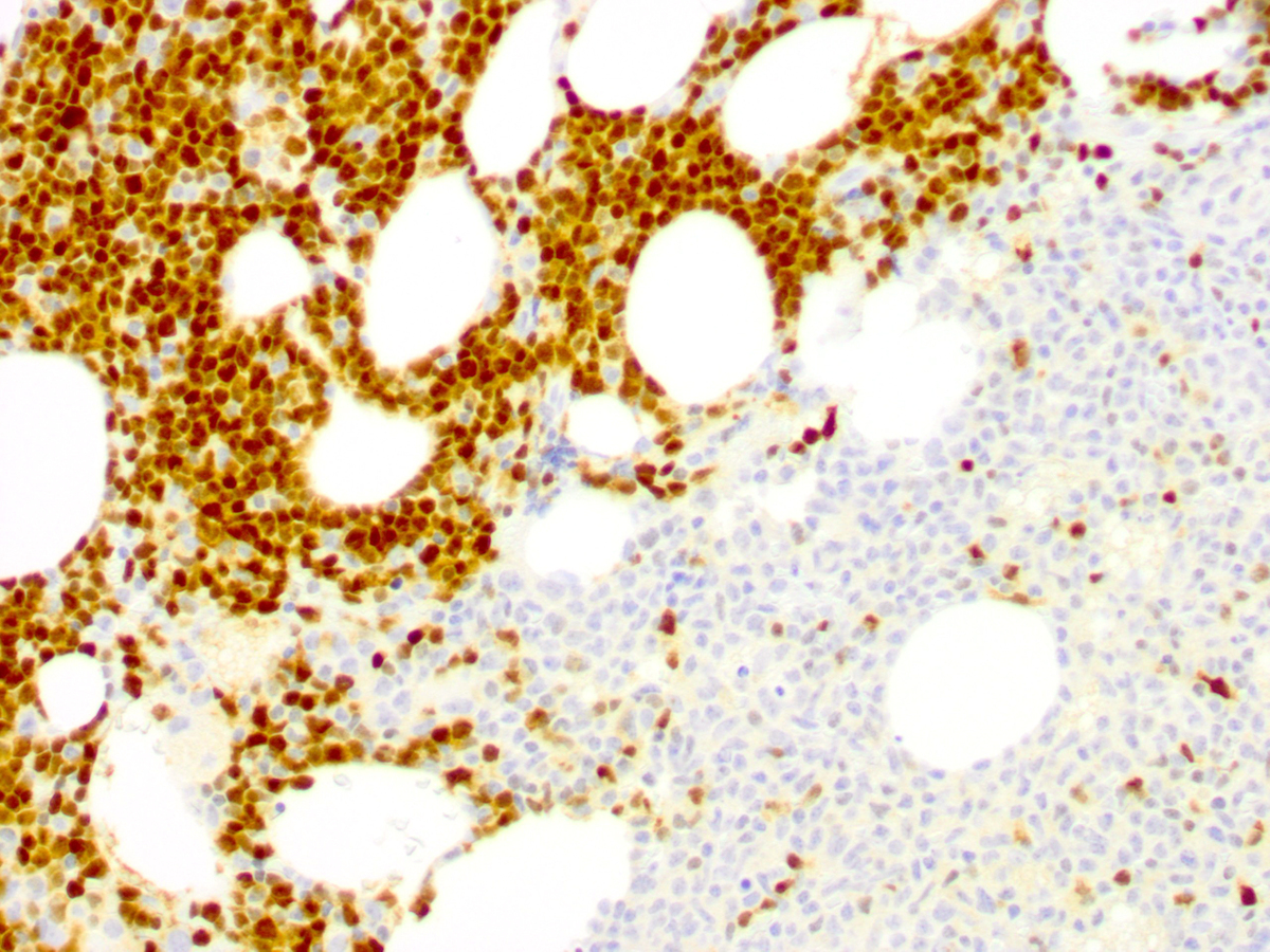 Immunohistochemical staining for TdT highlights sheets of blasts (left half of the image). The plasmacytoid dendritic cells do not express TdT (right half of the image)